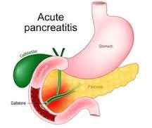 Understanding and Managing Chronic Pancreatitis Understanding and Managing Chronic Pancreatitis